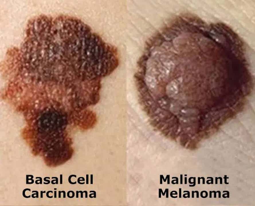 Skin cancer types - Basal Cell Carcinoma and Malignant Melanoma